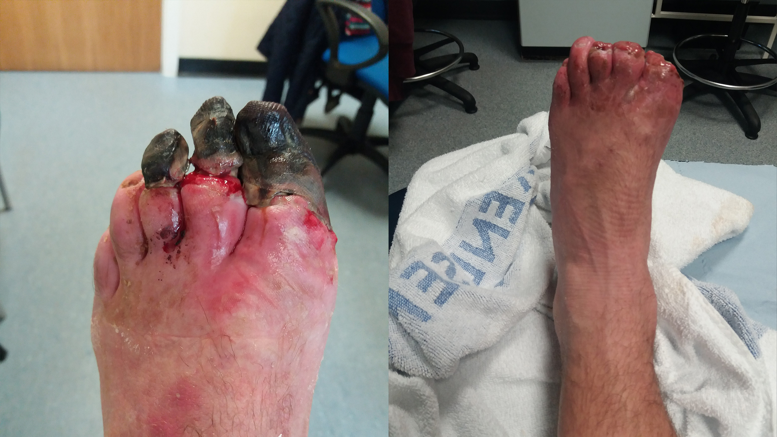 1560866480246-gnarlytoes