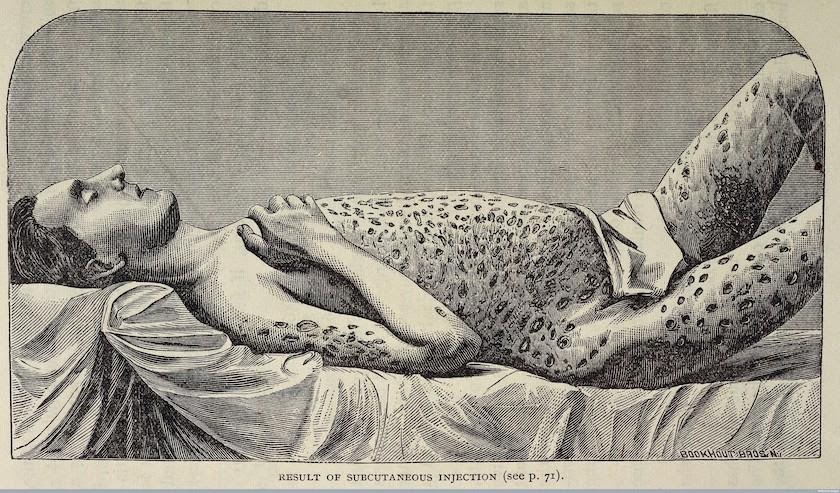 Engraving of a Civil War-era morphine user, documenting the abscesses that resulted from re-using dirty needles before “the germ theory of disease” became popular