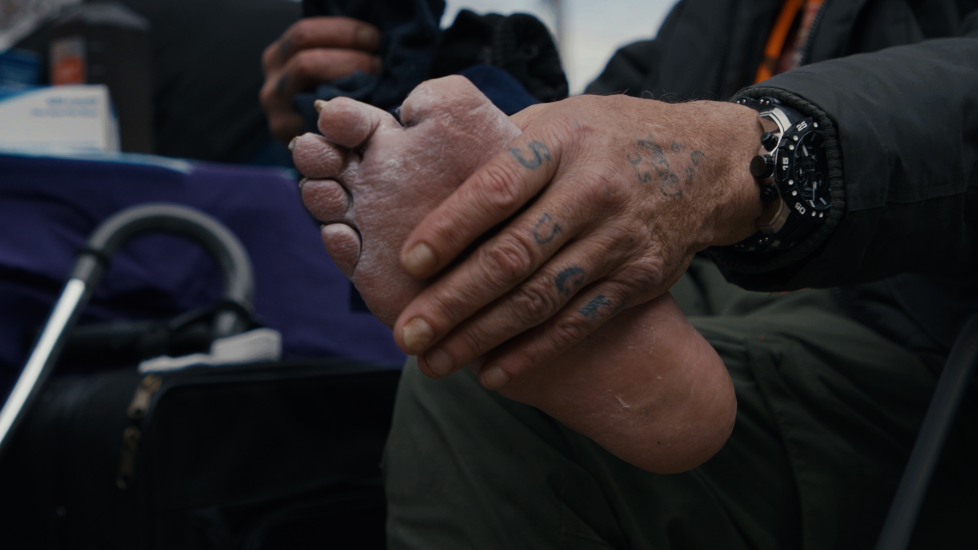 A man missing a toe receives wound care.