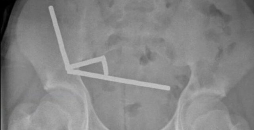 Teen Loses Part of Intestine After Swallowing 200 Magnets